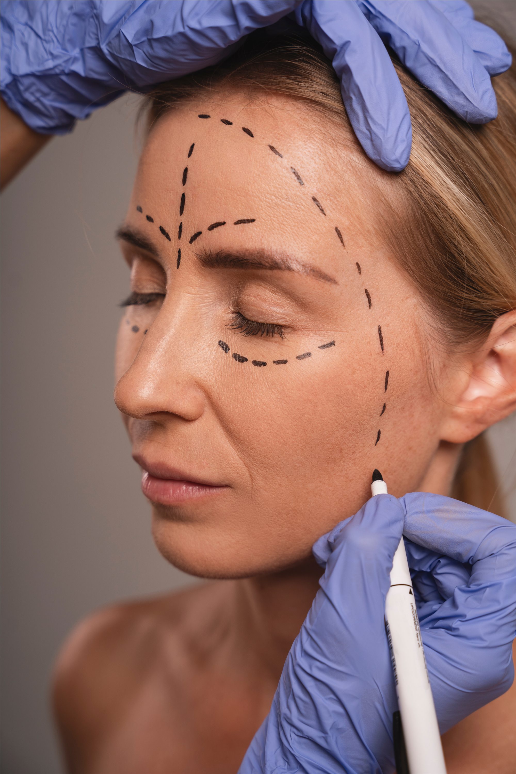 Marcação clínica no rosto antes de um procedimento facial